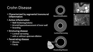 Small Bowel Inflammation [upl. by Bartie]