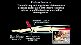 Phalanx Fractures  Everything You Need To Know  Dr Nabil Ebraheim [upl. by Blatman]