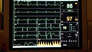 ECG  Extrasystole [upl. by Jedediah]