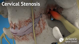 Cervical stenosis [upl. by Thayne]