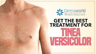 Best Tips for Tinea Versicolor Treatment Skin Fungus – Dr Berg [upl. by Burl]