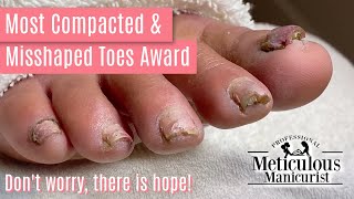 How to Pedicure Transformation the Most Compacted amp Misshapen Toenails [upl. by Ranger447]