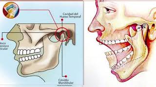 Luxación mandibular [upl. by Florence381]