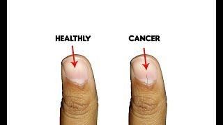 9 Fingernails serious alarming health issues and probllems [upl. by Solomon]