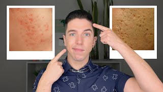 How to Get Rid of Acne Scars [upl. by Altman]