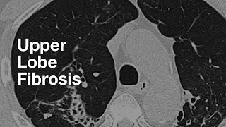 Upper Lung Predominant Fibrosis [upl. by Tatman111]