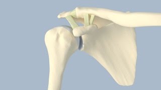 Acromioclavicular Separation Surgery [upl. by Idnahc74]