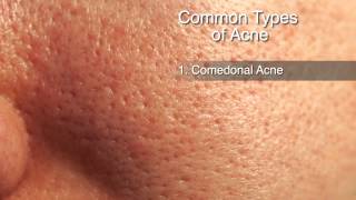 How to Treat Different Types of Acne [upl. by Eicyac]