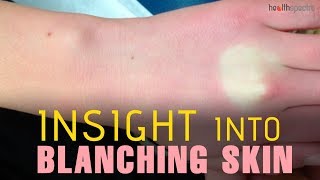 Blanching Skin  Causes Symptoms and Treatment [upl. by Madeline]