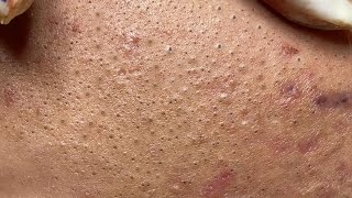 Satisfying Hien Spa Beauty Relaxing Video 28 [upl. by Surtimed]