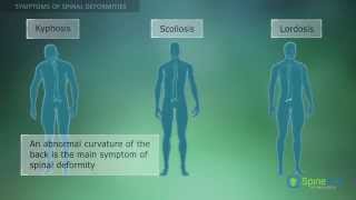 Spinal Deformities Symptoms [upl. by Ferriter]