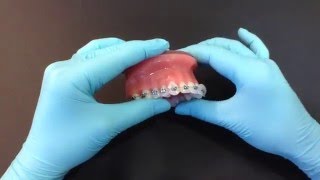 How to use orthodontic wax [upl. by Gnat173]