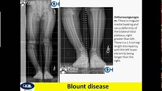 Blount disease [upl. by Klehm]