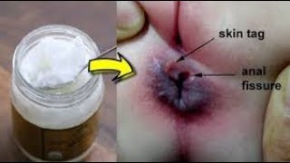 Coconut oil for hemorrhoids treatment at home Fast acting remedy [upl. by Labotsirhc]