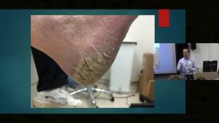 Itch in Elderly Skin  Dr Ian Bekker [upl. by Siberson]