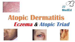 Eczema Atopic Dermatitis  Atopic Triad Triggers Who gets it Why does it happen amp Treatment [upl. by Theodore]