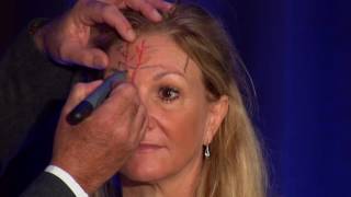 BOTOX® Injection  Forehead Wrinkles and Frown Lines  Atlanta Botox® [upl. by Anovad]