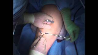 ACL Surgery  First Incision [upl. by Stucker]