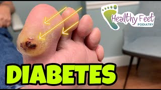 Diabetic Blister How to Treat Diabetic Ulcers [upl. by Graehl]