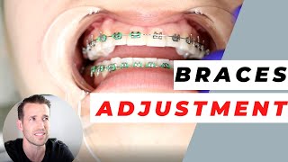 Orthodontist Explains Monthly Adjustments  Monthly Visits [upl. by Ramaj]