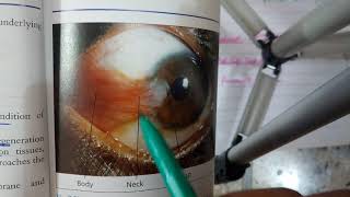 PTERYGIUM verry IMPORTANT conjuctival condition explanation with scenario [upl. by Behlke]