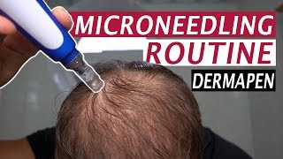 My Microneedling Routine and Derma Rolling for Hair Loss [upl. by Ashely]