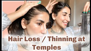 Hair Thinning At Temples or Receding Hair Line Cover Up with Nish Hair [upl. by Birkle]