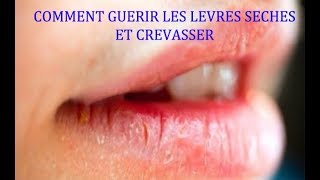 COMMENT SOIGNER LES LÈVRES SÈCHES ET CREVASSER [upl. by Eniowtna846]