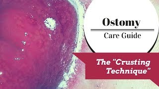 The Ostomy Crusting Technique Explained [upl. by Nagn334]