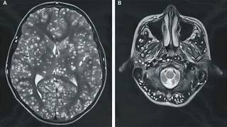 CISTICERCOSIS CAUSAS SÍNTOMAS Y TRATAMIENTO  EPILEPSIA POR CISTICERCOSIS  CISTICERCO CÓMO PREVENIR [upl. by Ereveniug]