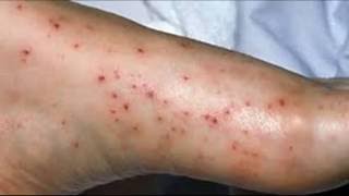 Comment traiter Pinpoint Petechiae [upl. by Cowley]