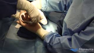 EndoTech® Endoscopic Carpal Tunnel Release  Fitzmaurice Hand Institute [upl. by Llenehc]