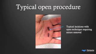 EndoTech® Endoscopic Trigger Finger Release  Fitzmaurice Hand Institute  Phoenix Arizona [upl. by Boj]