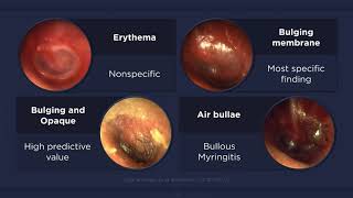 Acute Otitis Media Otoscopic Findings [upl. by Ruzich]