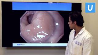 Achalasia What You Should Know [upl. by Tirrej]