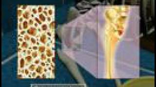 Osteoporosis3D Medical Animation [upl. by Anaej]