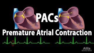 Premature Atrial Contractions PACs Animation [upl. by Modnar431]