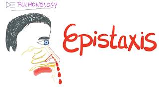 Epistaxis nosebleed Causes and Management [upl. by Marka]