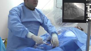 ARES  Angioplastie coronariana cu stent bioresorbabil Absorb  Dr Roberto Haret [upl. by Artnoed]