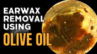 Painstaking Earwax Removal Using Olive Oil [upl. by Johnson]