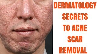 Acne scar treatments ULTIMATE GUIDE [upl. by Rhiamon]