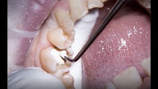 Treating secondary caries with Biodentine by Dr Nicola Bone [upl. by Letnohc113]