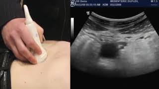 sonography of Mesenteric Duplex Examination [upl. by Porty75]