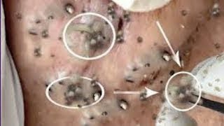 Best Pimple Popping Videos 2021  Blackheads Removal 021 [upl. by Marlow]