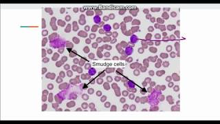 Chronic Lymphocytic Leukemia CLL [upl. by Belva408]