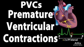 Premature Ventricular Contractions PVCs Animation [upl. by Clarice128]