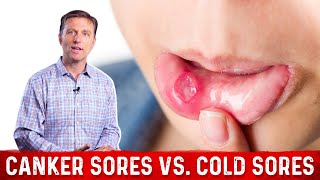 Canker Sores Vs Cold Sores – Dr Berg on Mouth Sores [upl. by Mccowyn]