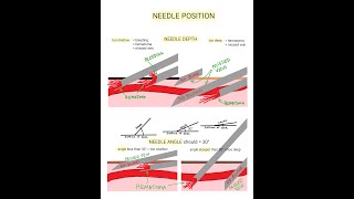 Venipuncture  How to Position a Needle [upl. by Eelidnarb]