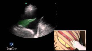 How To Ultrasound Guided Thoracentesis Exam 3D Video [upl. by Eivla834]