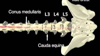 NEJM  Lumbar Puncture [upl. by Major857]